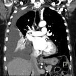 Computertomographie (CT)