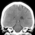 Computertomographie (CT)