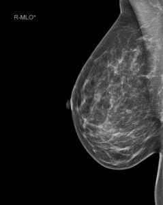 Mammographie und Ultraschall (Sonographie)